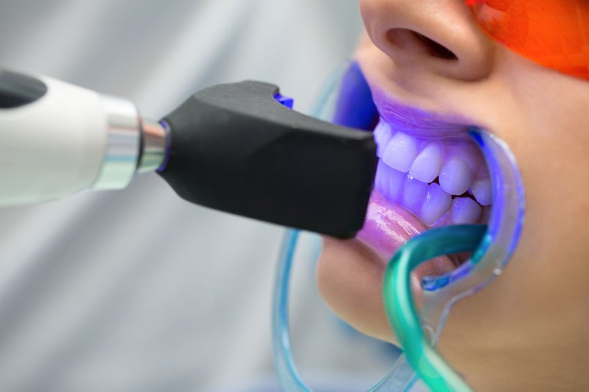 51062335_web-blanqueamiento-dental